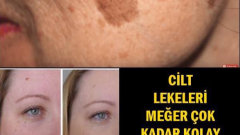 Cilt Lekelerinden Kurtulmak Bu Kadar Kolaymış Bakın Nasıl