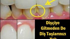 Dişçiye Gitmeden De Diş Taşlarınızı Yok Edebileceğiniz Doğal Karışım