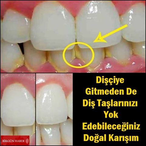 Dişçiye Gitmeden De Diş Taşlarınızı Yok Edebileceğiniz Doğal Karışım