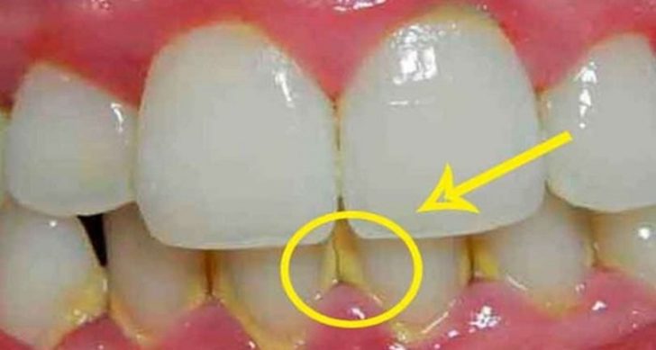 Dişçiye Gitmeden De Diş Taşlarınızı Yok Edebileceğiniz Doğal Karışım