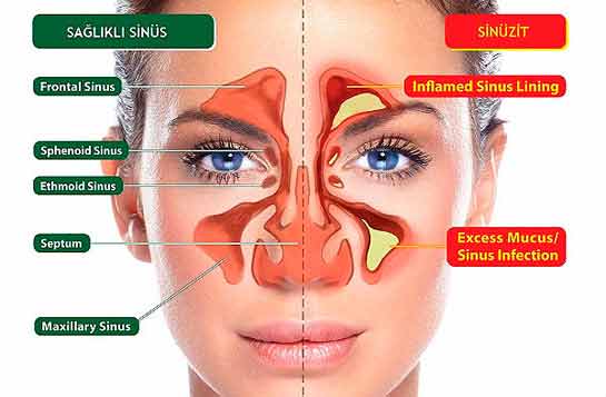 Sinüzit, balgam ve gribe bu iki malzeme ile son verin