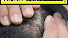 Kafa derisinde sivilce varsa dikkat Bu Haberi Okumadan Geçmeyin