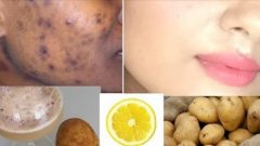 Siyah lekeleri sivilceleri sadece 5 gün içinde yok eder