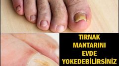 Tırnak Mantarını Evde Yok Edebilirsiniz Hemde Bakın O Kolay Yöntem Nasıl