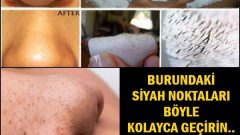 Burundaki Siyah Noktaları Böyle Geçirin İşte O Yöntem