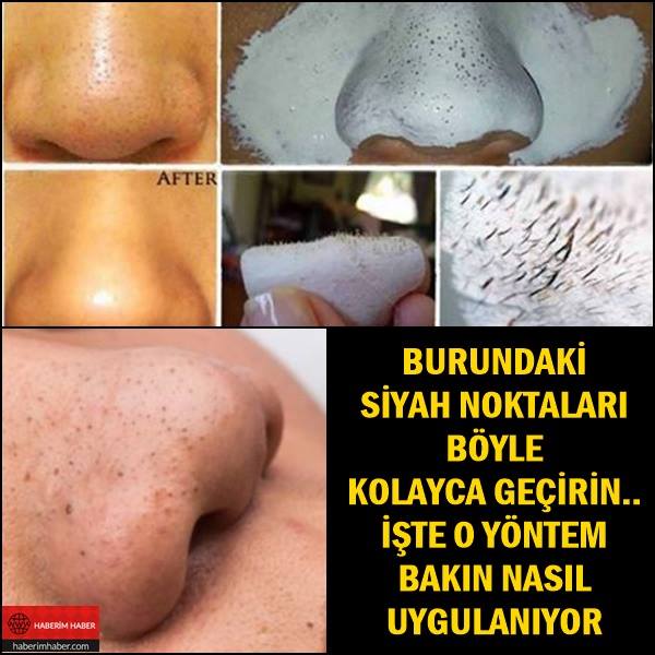 Burundaki Siyah Noktaları Böyle Geçirin İşte O Yöntem