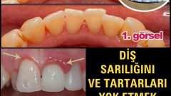Diş Sarılığını Ve Tartarlarını Yok Etmek Bu Yöntem İle Çok Basit