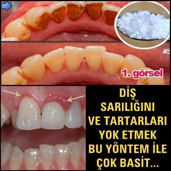 Diş Sarılığını Ve Tartarlarını Yok Etmek Bu Yöntem İle Çok Basit