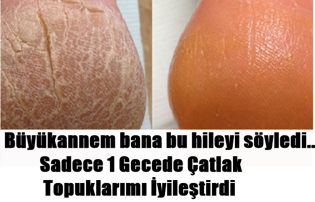 Büyükannem bana bu hileyi söyledi.. Sadece 1 Gecede Çatlak Topuklarımı İyileştirdi