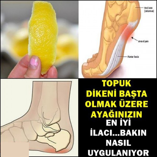 Topuk Dikeni Başta Olmak Üzere Ayak İçin En İyi İlaç Bakın Neymiş