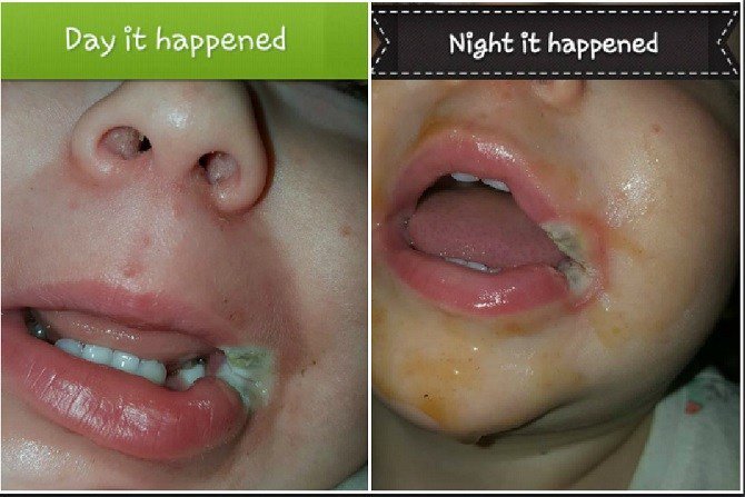 Bebeğinin Ağzı Bir Şarj Cihazının Ucundan Yanınca Herkesi Uyaran Anne