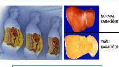 Karaciğer Yağlanmasını En Aza İndiren ve Kilo Verdiren 3 Günlük Kür