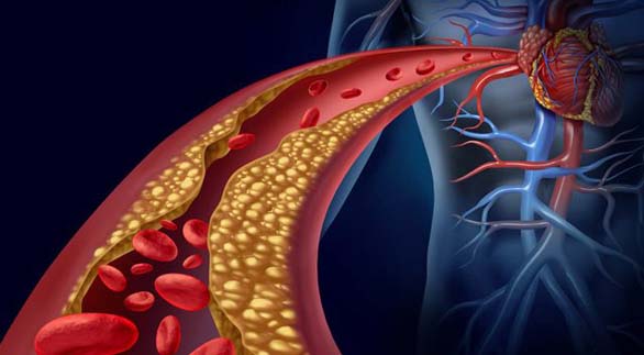 Damarlarda Biriken Kolesterolü Temizleyin