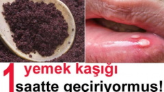Ağızda Meydana Gelen Aft Yaralarını 1 Saatte Geçiren Muhteşem Yöntem