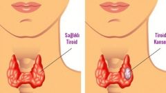 Tiroid Problemlerinizi Doğal Yollarla Nasıl İyileştirebilirsiniz