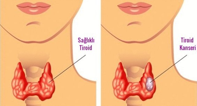 Tiroid Problemlerinizi Doğal Yollarla Nasıl İyileştirebilirsiniz