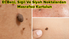 Uzmanlar Et Beni Siğil Ve Siyah Noktalardan Kurtulmanın  Yöntemini Açıkladılar