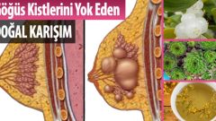Göğüs Kistlerini Yok Eden Doğal Karışım