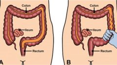 Bu Kür Bağırsak Kolonlarını Tamamen Temizliyor ve Yüzde Yüz Doğaldır