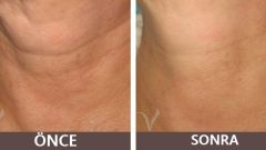 Boyun Sarkmaları ve Kırışıklıkları Kader Değil İşte Mucizevi Yağ