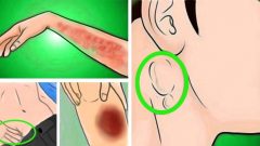 Kanserin 10 Sinsi Belirtisi Erken Teşhis Edilirse Tedavisi