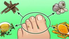 Ayak nasırlarını kökünden kazıyan evde yapabileceğiniz denenmiş kanıtlanmış Yöntem