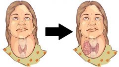 Tiroid’i Tetikleyen 5 Kötü Alışkanlık  Bu Alışkanlıklarınızdan Mutlaka Kurtulun