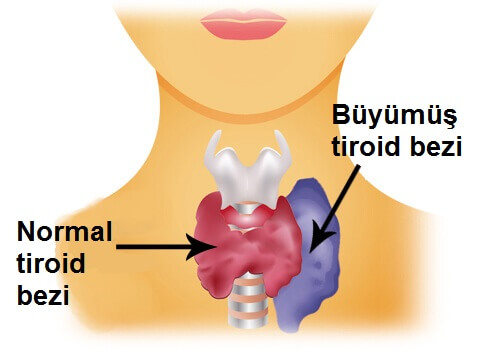 İşte Tiroid Hastası Olduğunuzun 6 Gizli İşareti