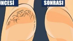 Yaşlı Kadın Topuğundaki Çatlaklardan Böyle Kurtuldu