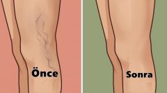 Varisin Evde Doğal Tedavisi Mümkün Hem de Tek Bir Malzeme ile