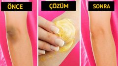 Koyu diz ve dirseklerden kurtulmanın etkili yolları