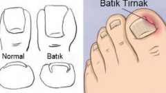 Tırnak batması nasıl geçer? Tırnak batmasına doğal çözüm