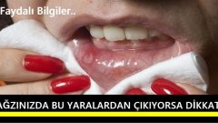 Ağzınızda Bu Yaralardan Çıkıyorsa Dikkat