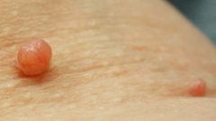 Bu Doğal Sıvıyı Cildinize Sürün ve Et Benlerinden Kurtulun