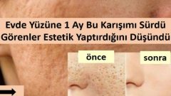 Siz de Gözeneklerinizden Şikayetçi misiniz