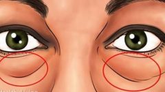 Göz Altı Torbaları ve Mor Halkalardan Kurtulmanın Doğal Yolları