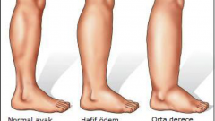 Vücutta Oluşan Ödem’in Nedenleri ve Doğal Çözümleri