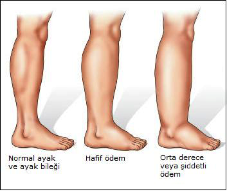 Vücutta Oluşan Ödem’in Nedenleri ve Doğal Çözümleri