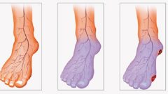 Bir Türlü Isınamayan Soğuk El ve Ayaklar İçin Çözüm Önerileri