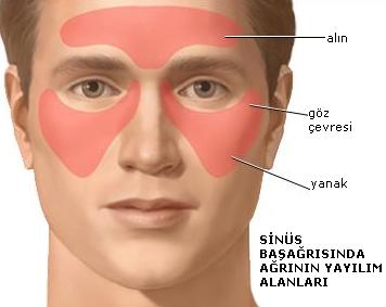 Sinüzit ve Migren Ağrılarına Bu Şekilde Son Verebilirsiniz