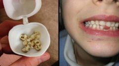 Çocuğunuzun Süt Dişlerini Asla Atmayın! Bakın Gelecekte Ne İşe Yarayacak