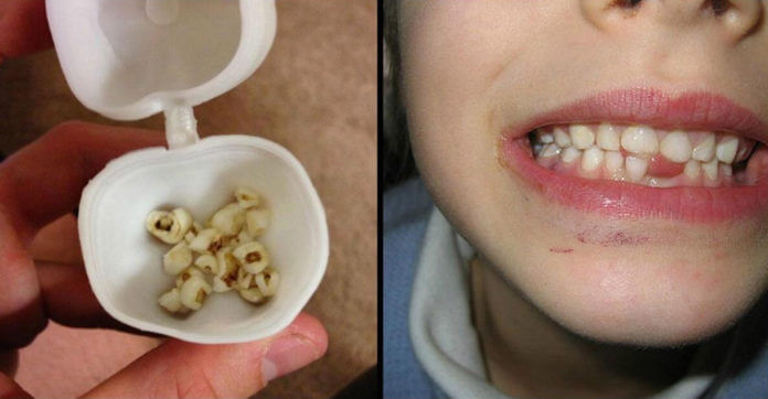 Çocuğunuzun Süt Dişlerini Asla Atmayın! Bakın Gelecekte Ne İşe Yarayacak