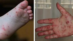 Uzmanlar Dünyada Hızla Yayılan Ve Sadece Çocukları Etkileyen Salgın