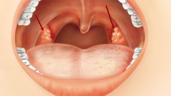 Paslı Bademcik Sorunundan 1 Günde Kurtulun