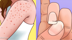 Bu Belirtiler Sessiz Katil Glüten Duyarlılığınızı Gösteriyor