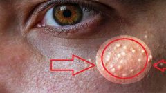 Siz de mi Bu Küçük Kistlerden Bıktınız.Aslında Kurtulmak Çok Basit