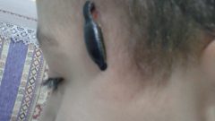 Çocukların tedavisi için Sülük tedavisi