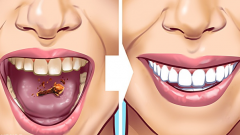 Dişlerinizdeki Tartarları Çıkarmanın 10 Yolu