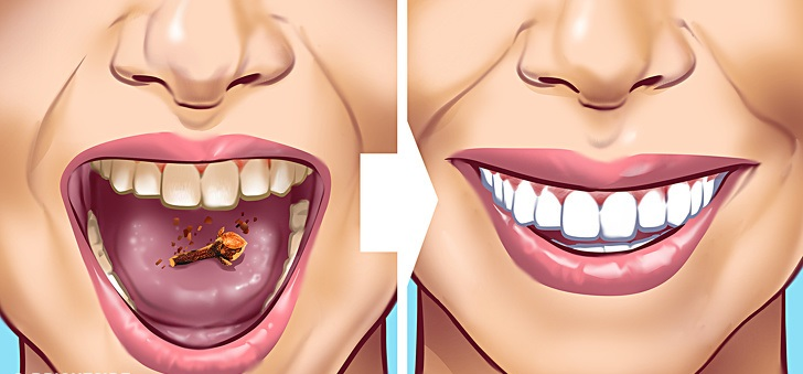 Dişlerinizdeki Tartarları Çıkarmanın 10 Yolu