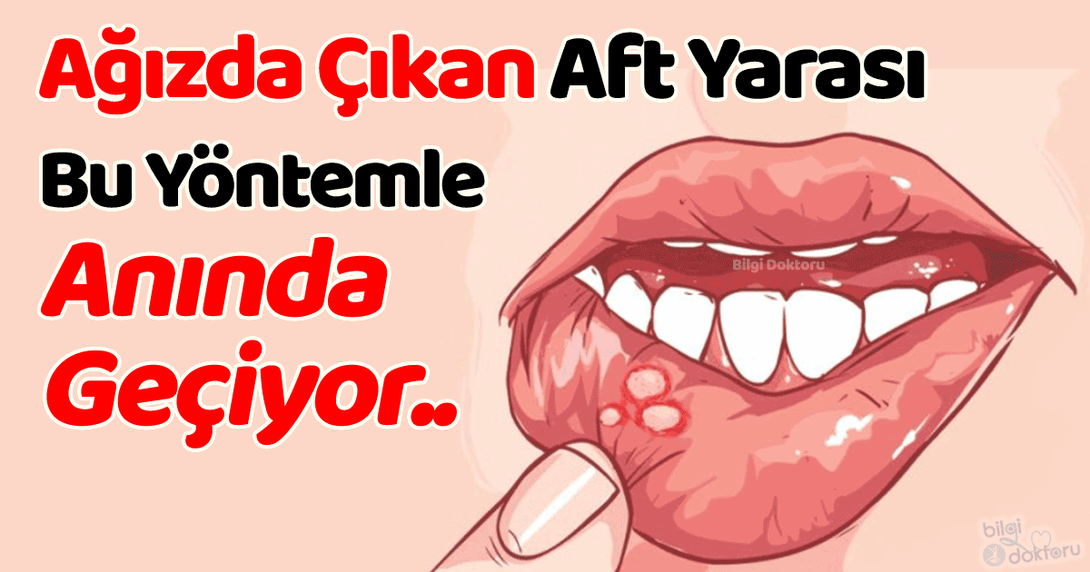 Aft Yarası Neden Çıkar, Kaç Günde Nasıl Geçer?